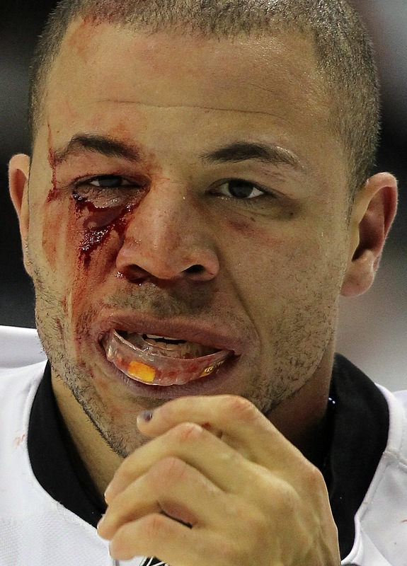 [Image: 101223_bloody-jarome-iginla__getty.jpg]